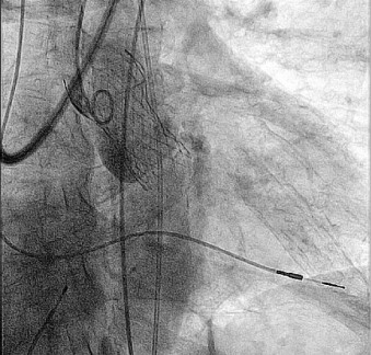 PROTESIS DE AORTA- TAVI web